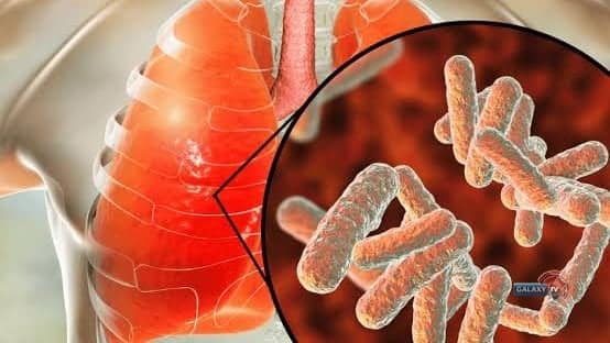 Plateau Diphtheria Outbreak Escalates: 31 Dead, 469 Under Surveillance Across 10 LGAs